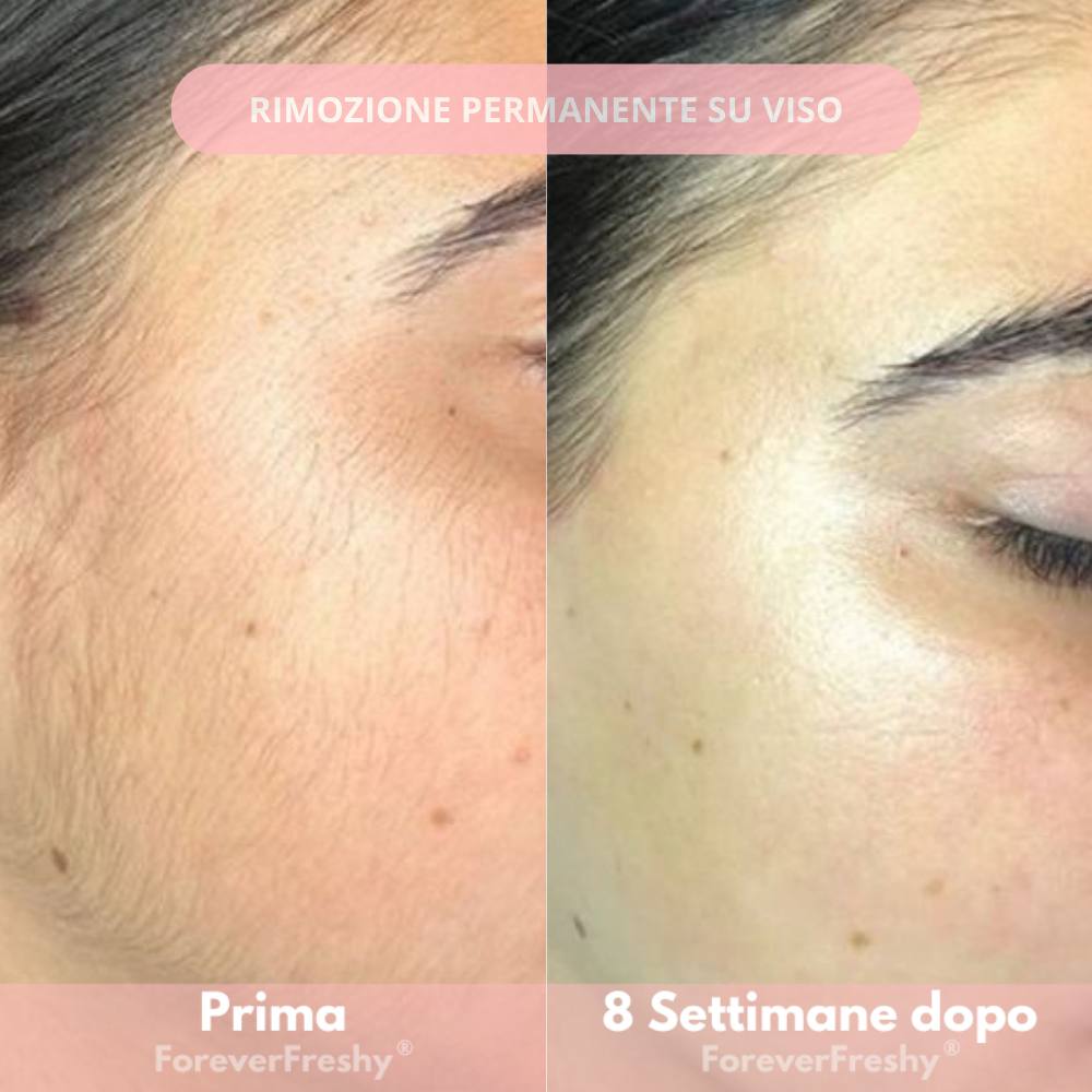 Freshy® depilatore a luce pulsata