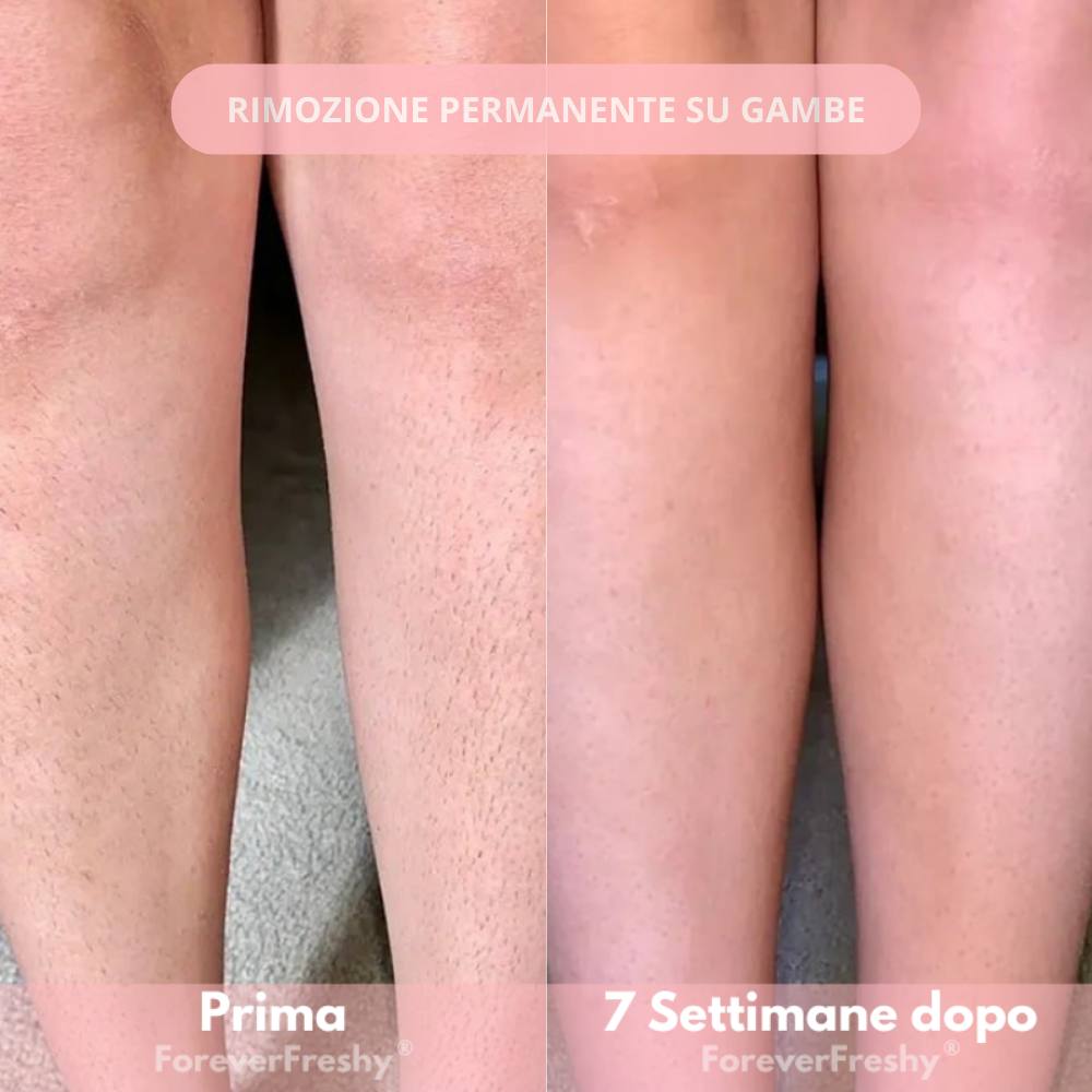 Freshy® depilatore a luce pulsata